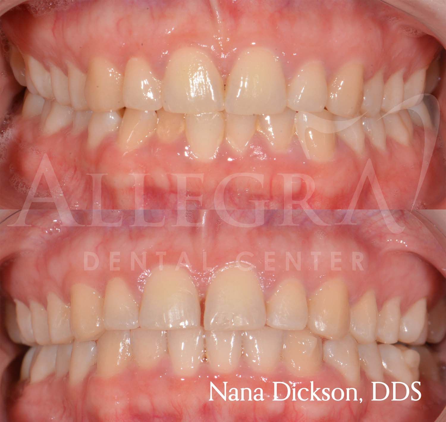 Invisalign case 1 from Allegra Dental Center