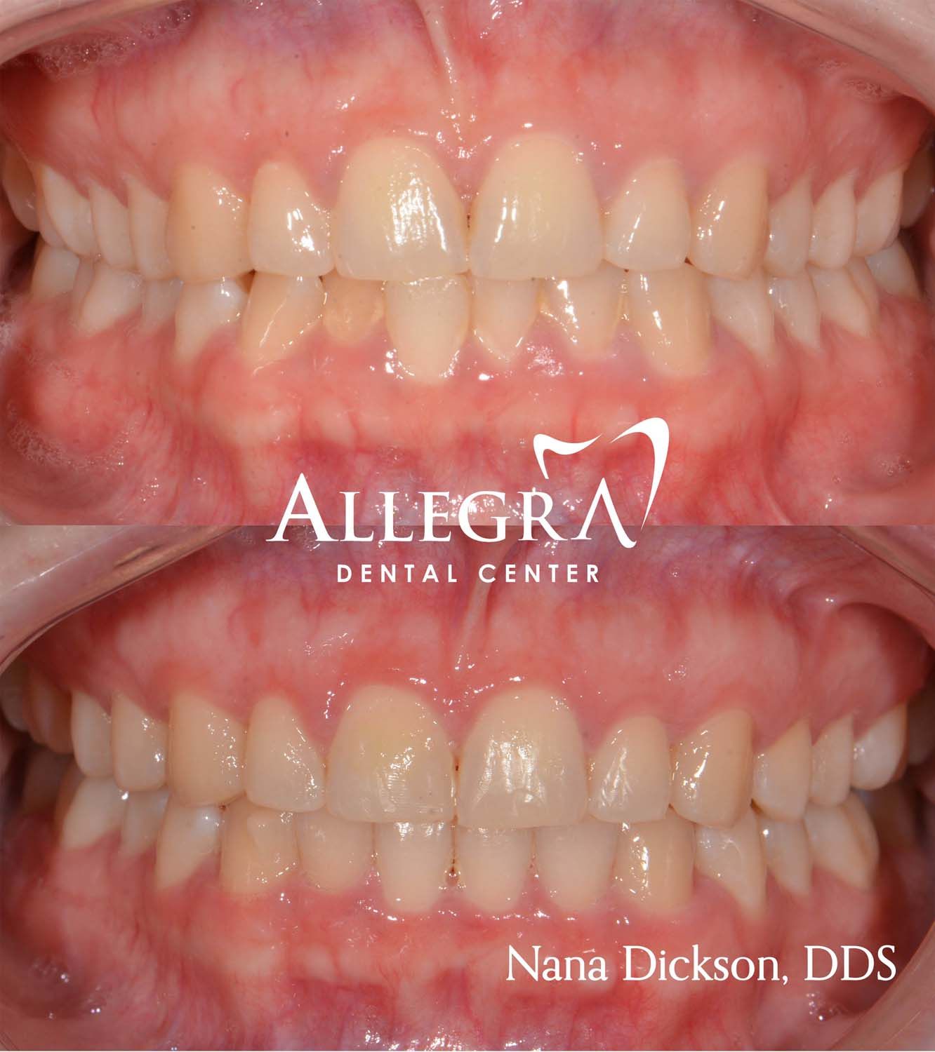 Invisalign case 2 from Allegra Dental Center