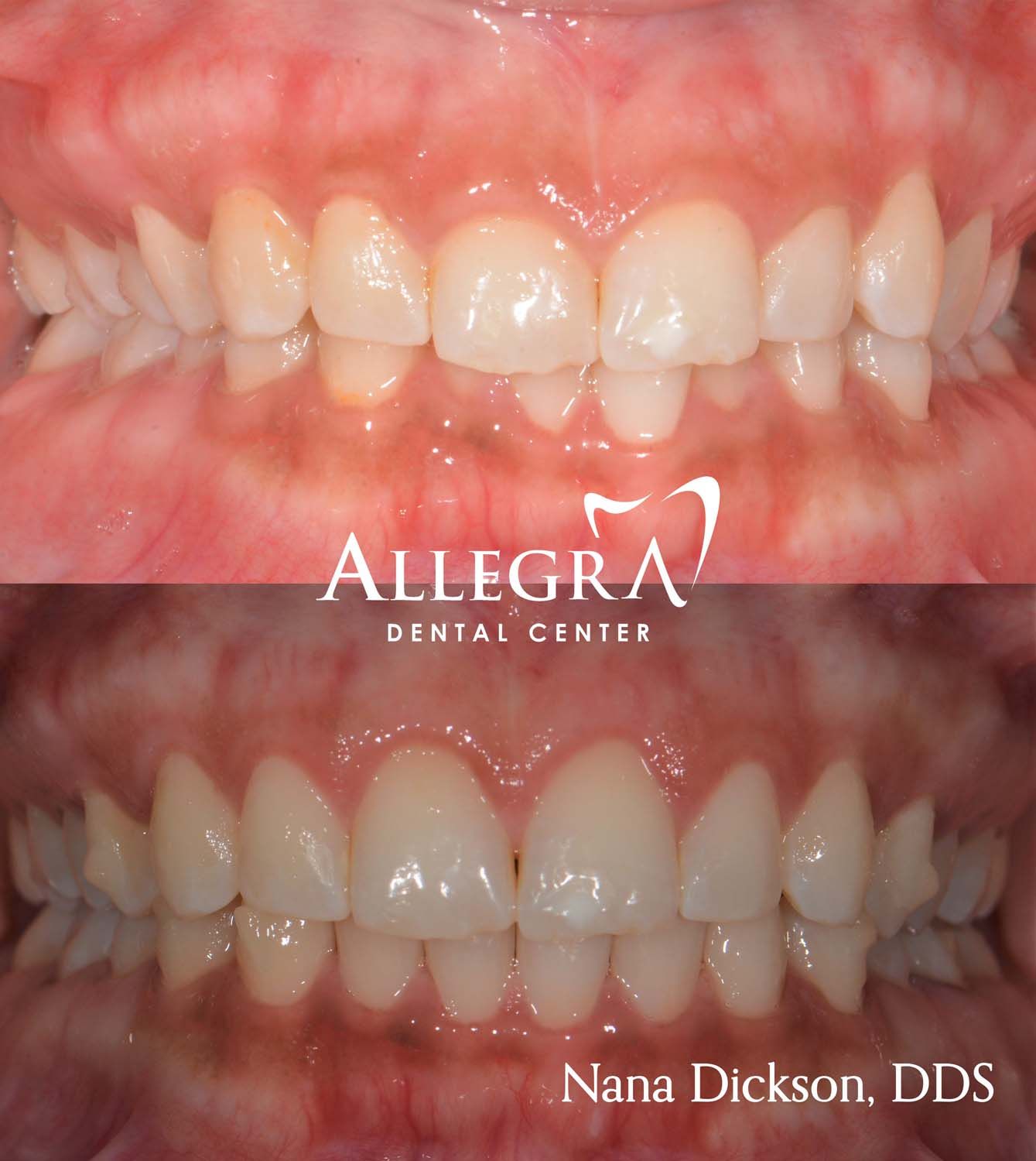 Invisalign case 3 from Allegra Dental Center