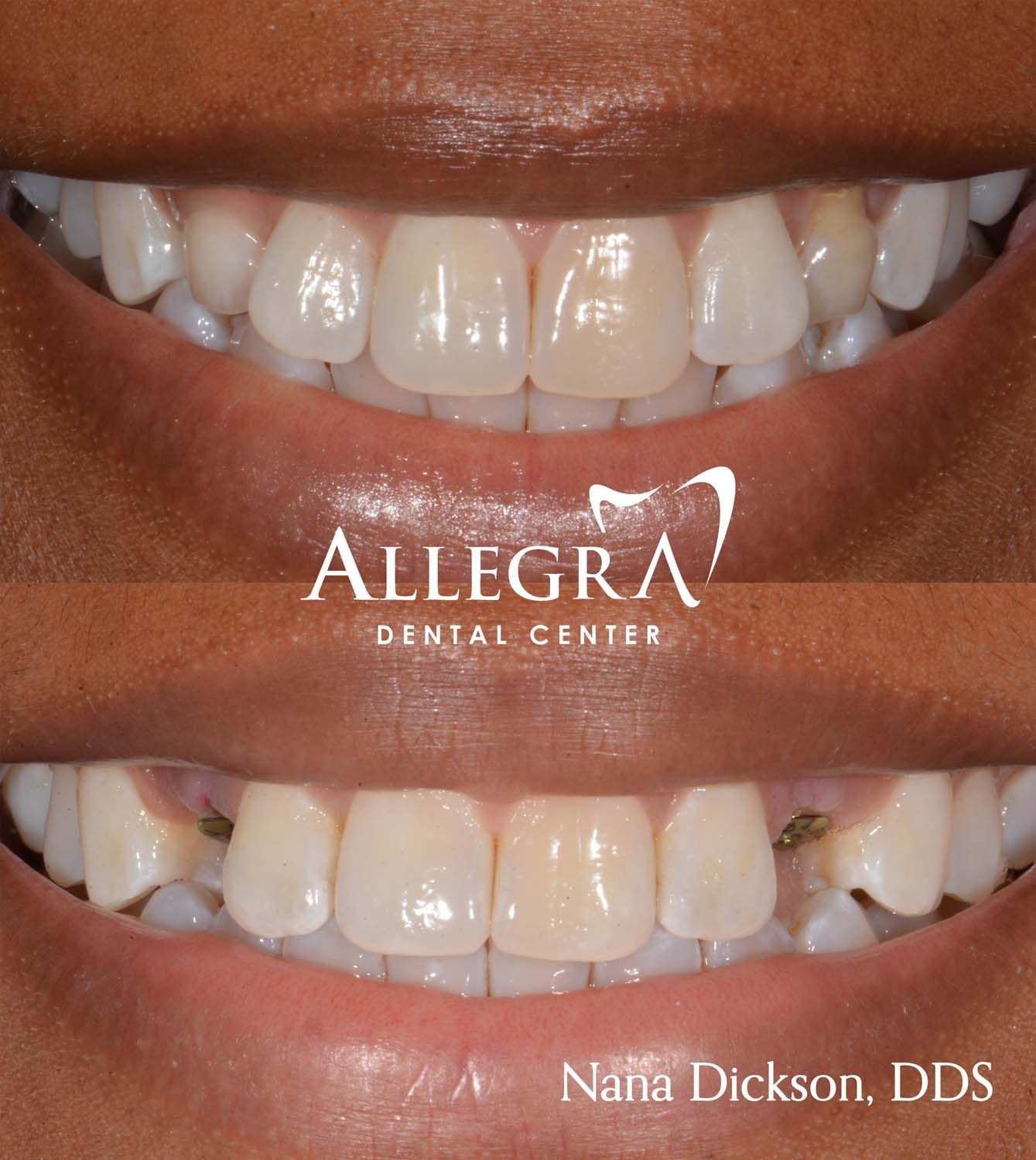 Invisalign Before and After case 5 from Allegra Dental Center