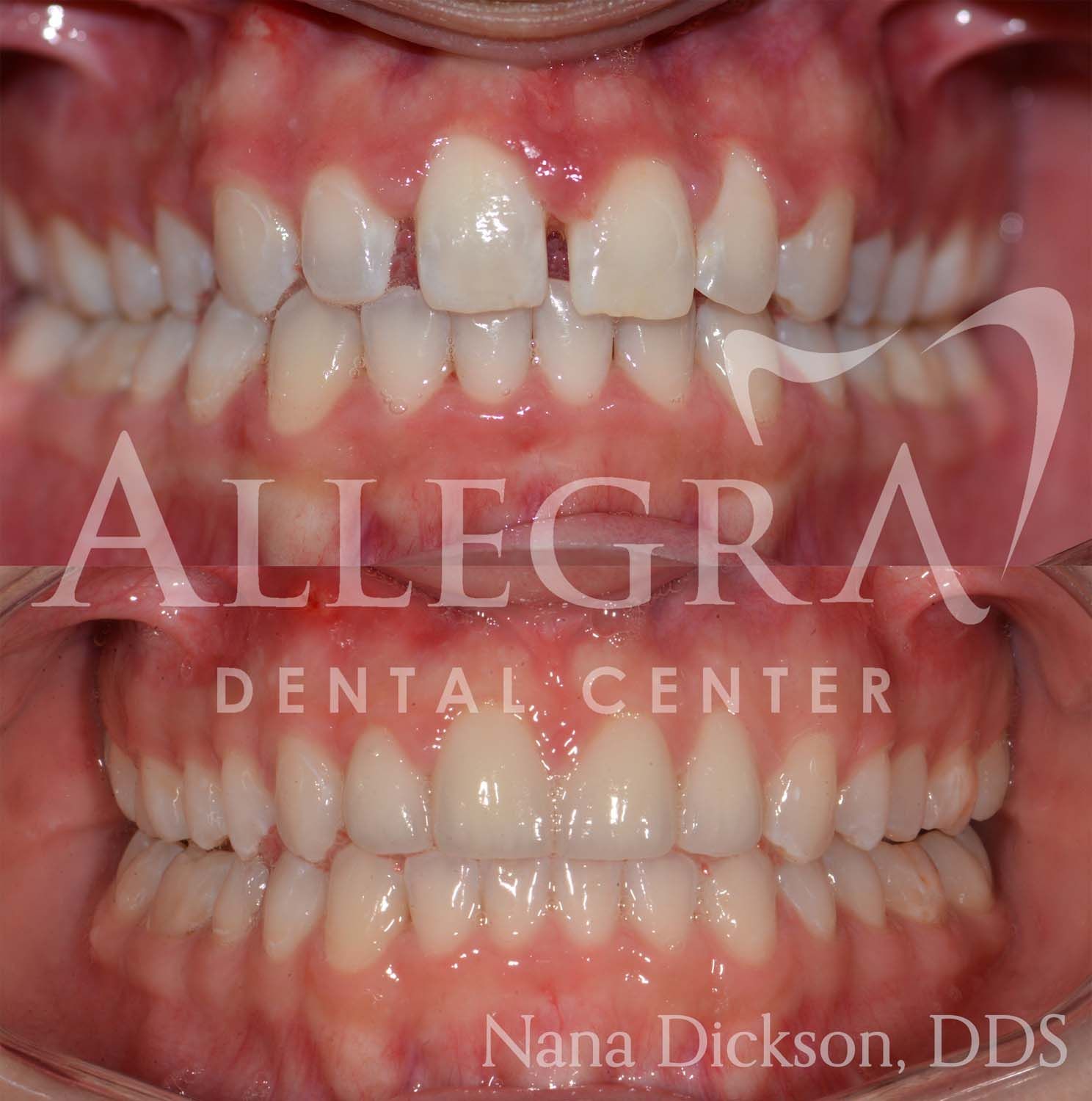 Invisalign Before and After case 8 from Allegra Dental Center
