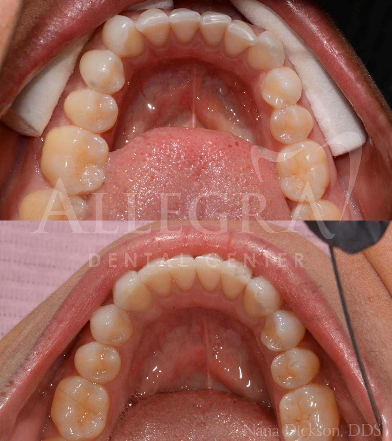 Invisalign Before and After case 9 from Allegra Dental Center