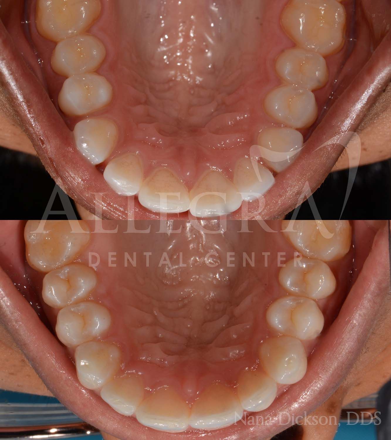 Invisalign Before and After case 10 from Allegra Dental Center