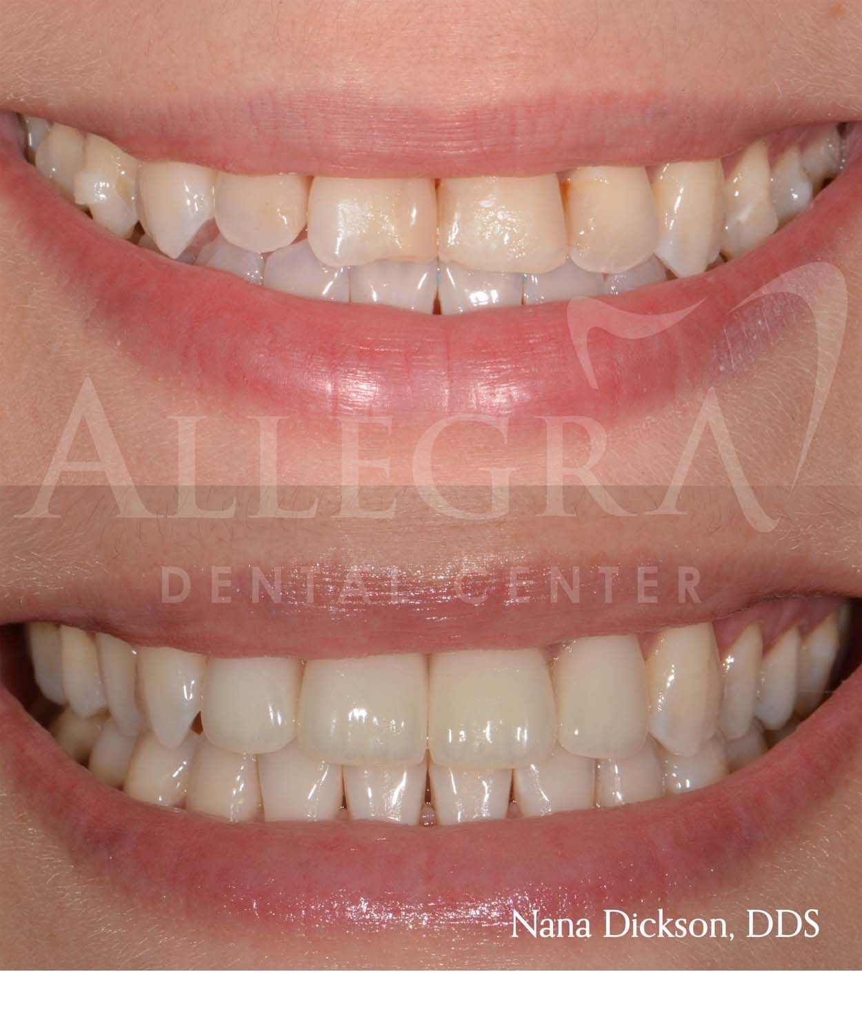 Invisalign Before and After case 12 from Allegra Dental Center