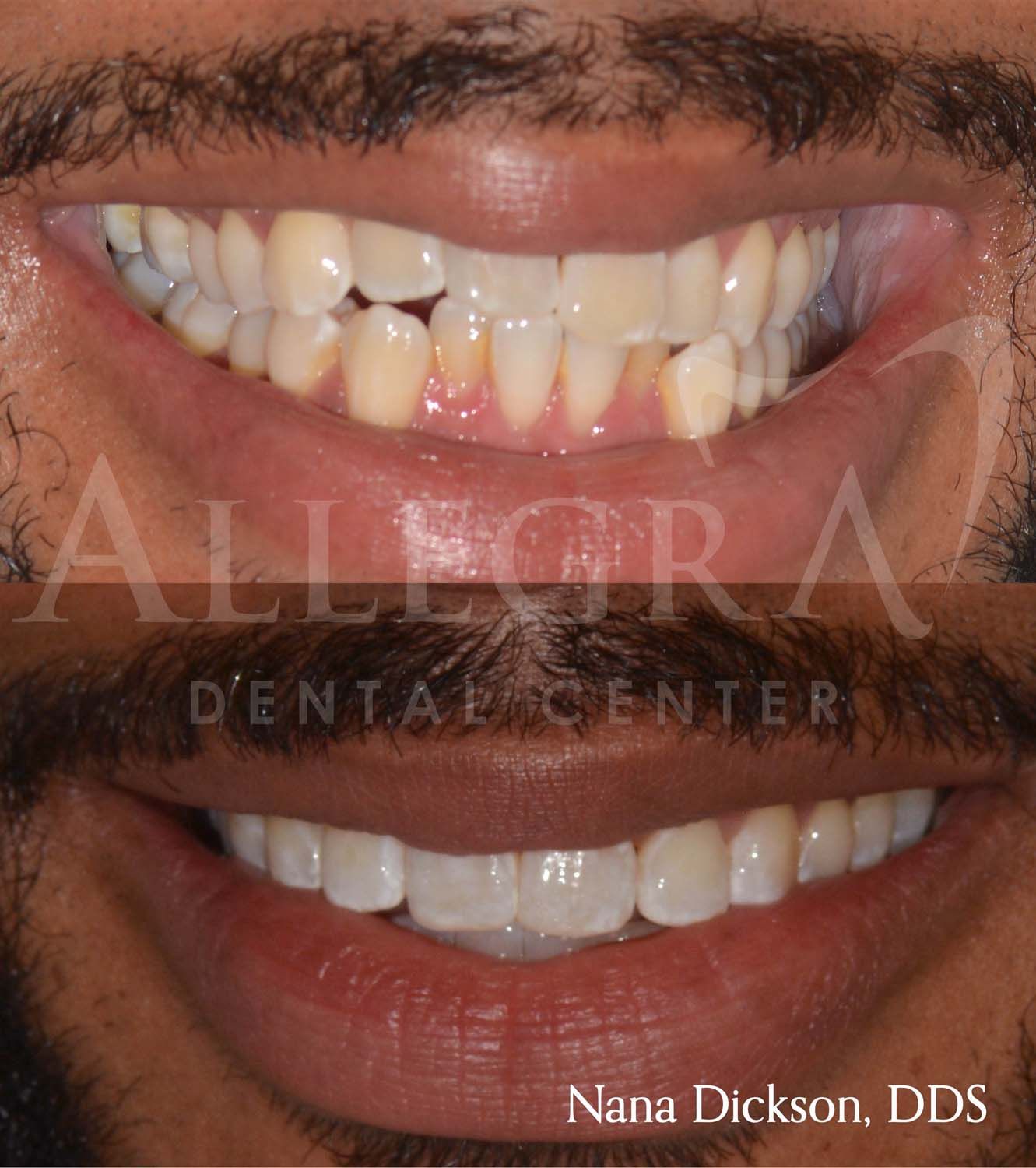 Invisalign Before and After case 13 from Allegra Dental Center