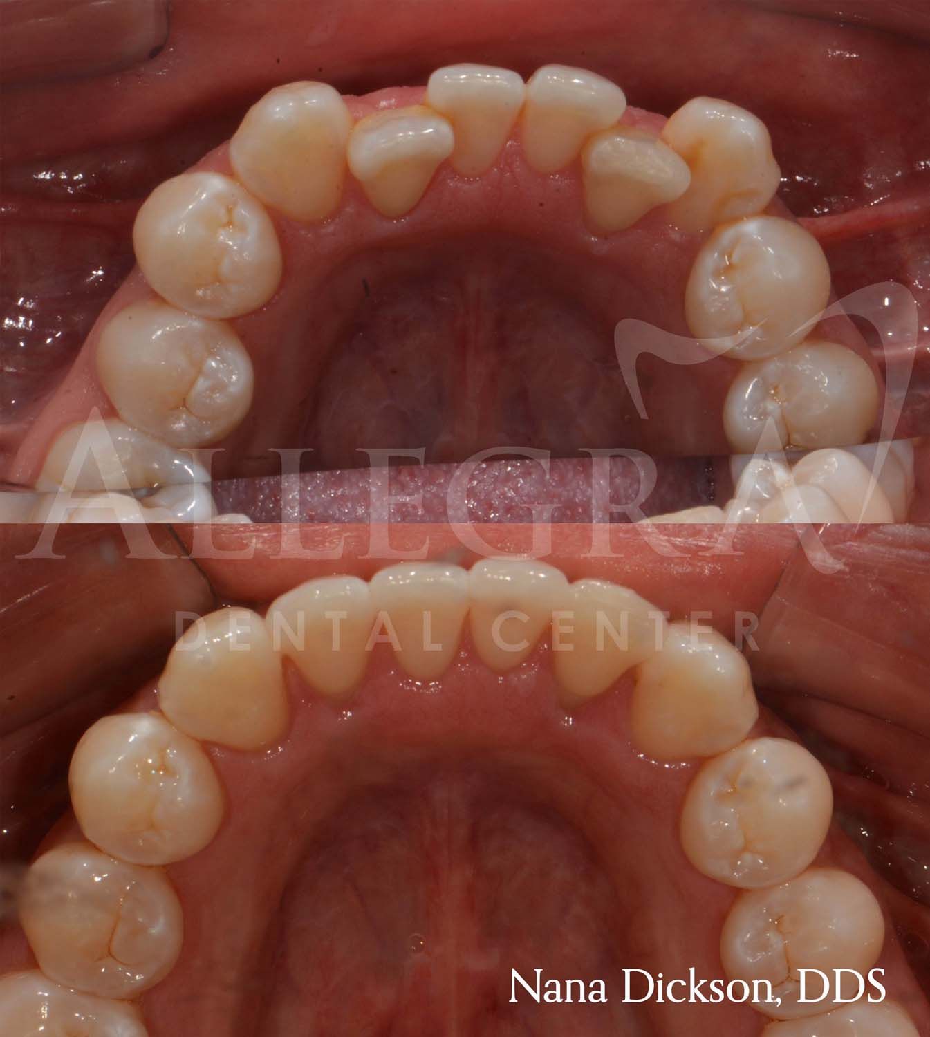 Invisalign Before and After case 14 from Allegra Dental Center
