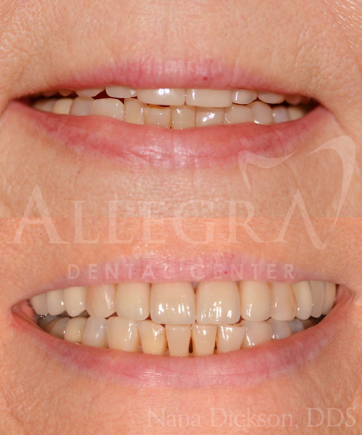 Invisalign Before and After case 19 from Allegra Dental Center