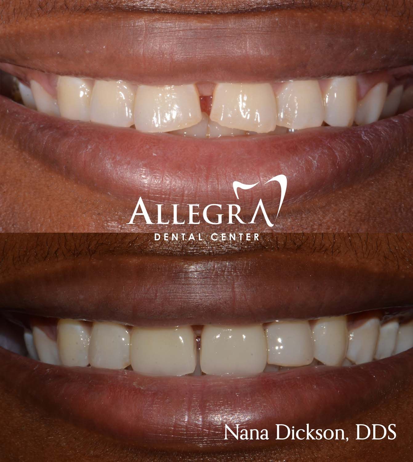 Invisalign Before and After case 21 from Allegra Dental Center