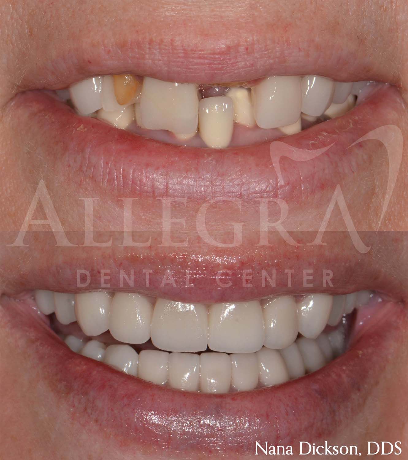 Invisalign Before and After case 24 from Allegra Dental Center