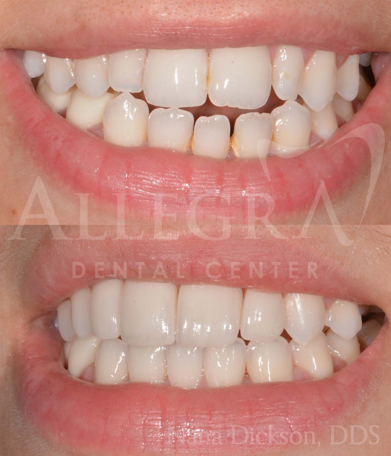 Invisalign Before and After case 25 from Allegra Dental Center