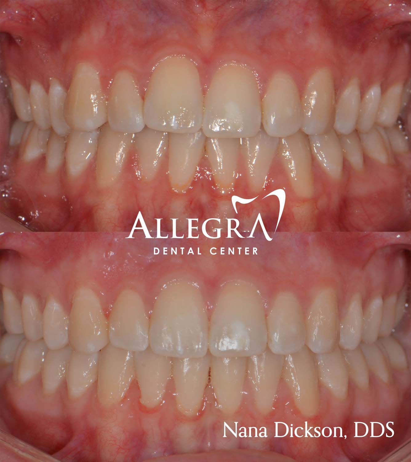 Invisalign Before and After case 28 from Allegra Dental Center