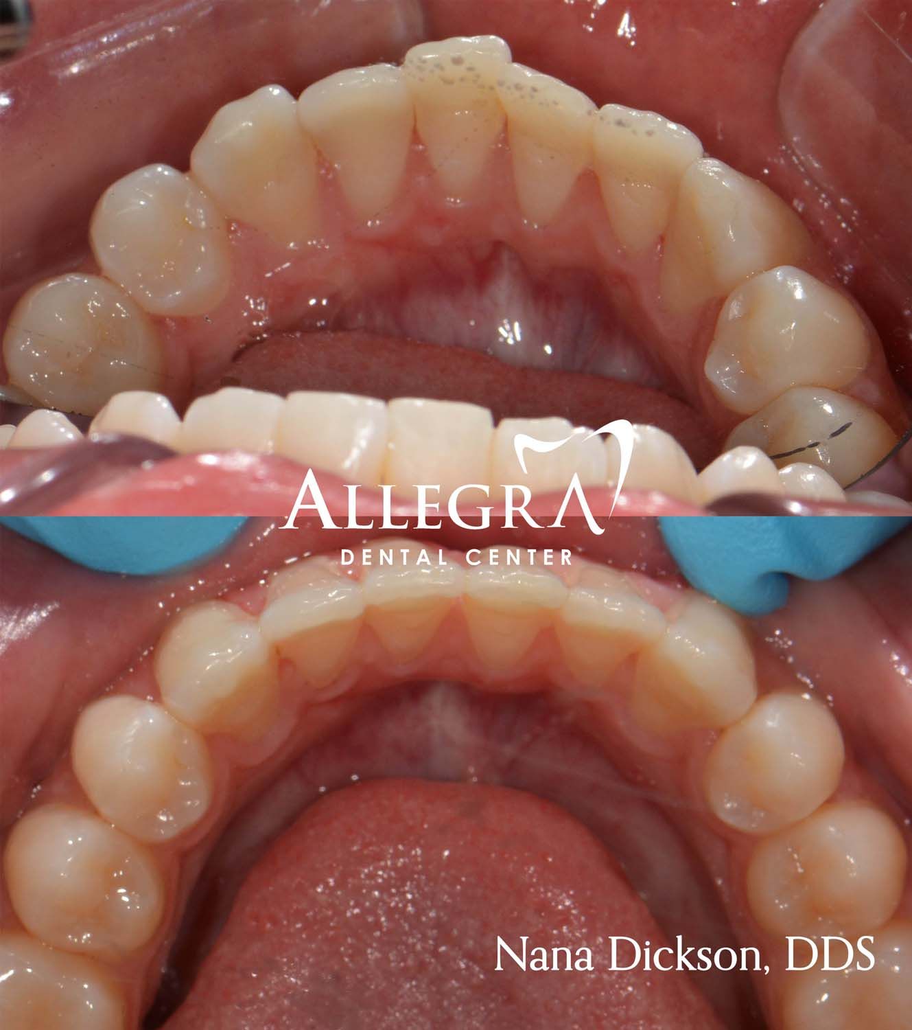Invisalign Before and After case 29 from Allegra Dental Center