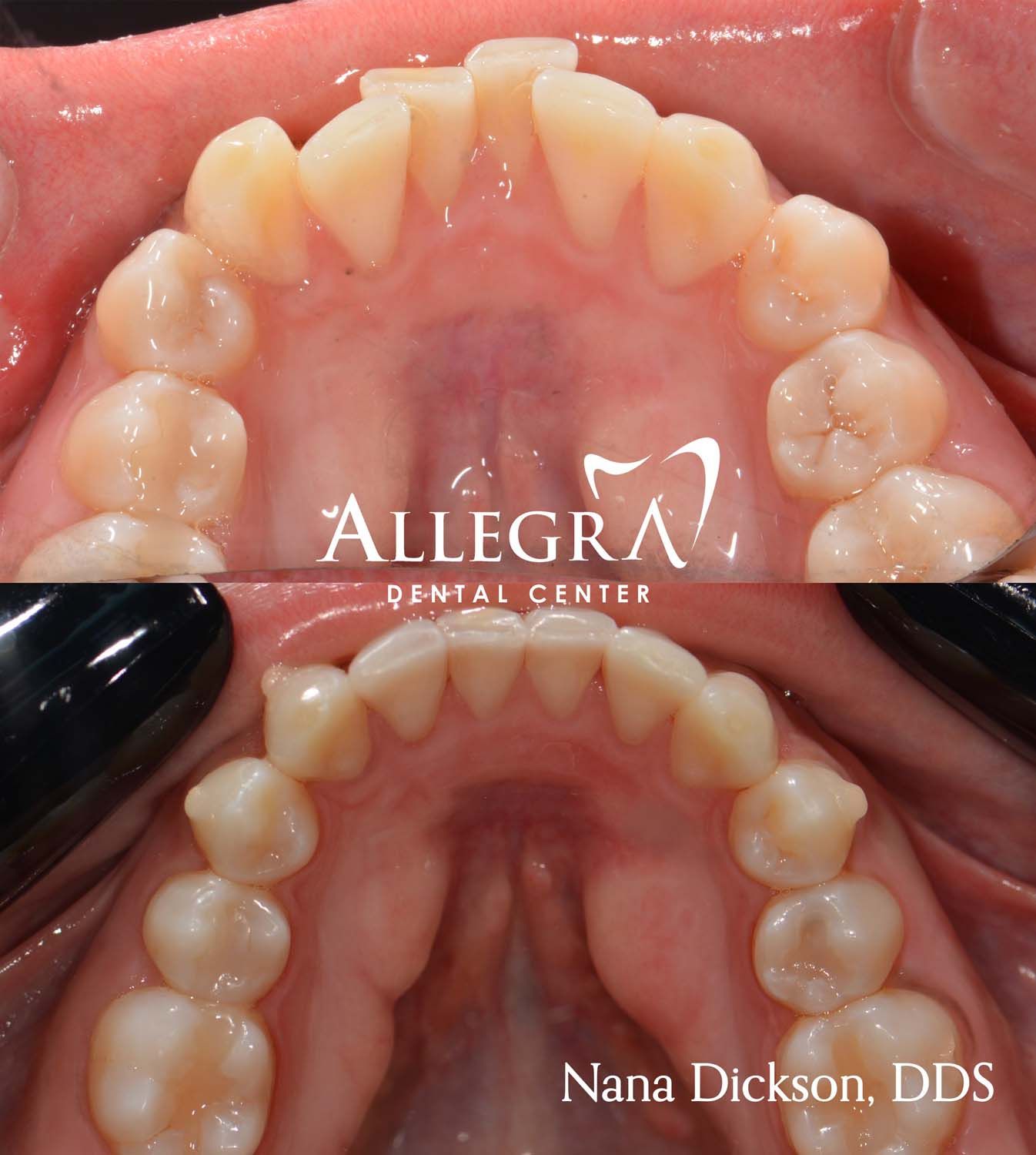 Invisalign Before and After case 33 from Allegra Dental Center