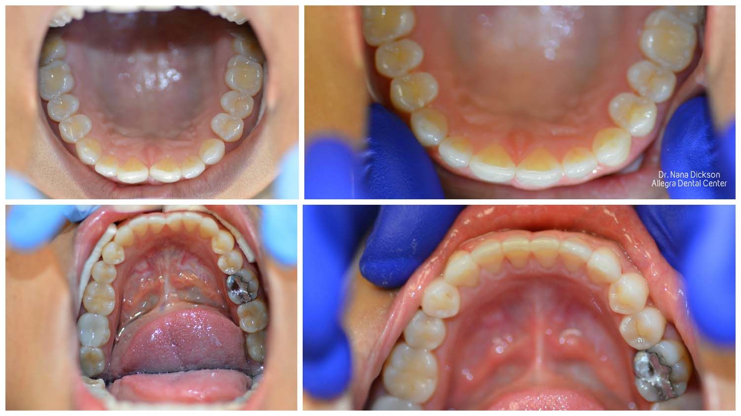 Invisalign Before and After case 34 from Allegra Dental Center