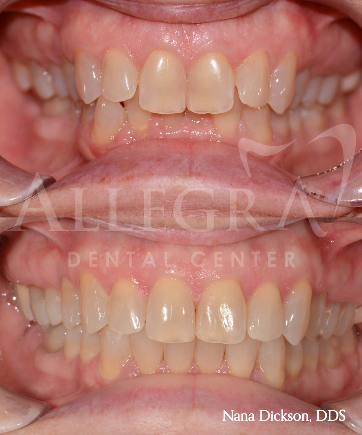 Invisalign Before and After case 36 from Allegra Dental Center