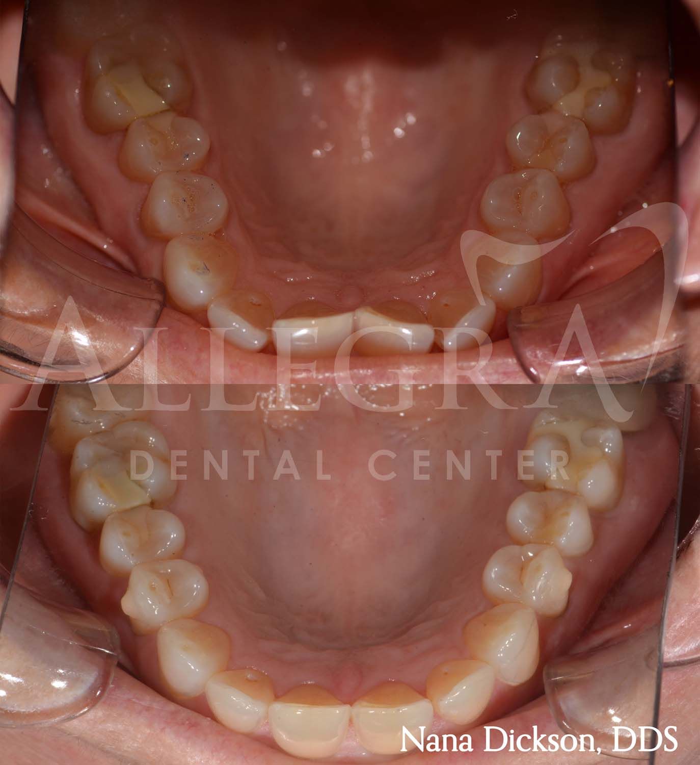Invisalign Before and After case 38 from Allegra Dental Center