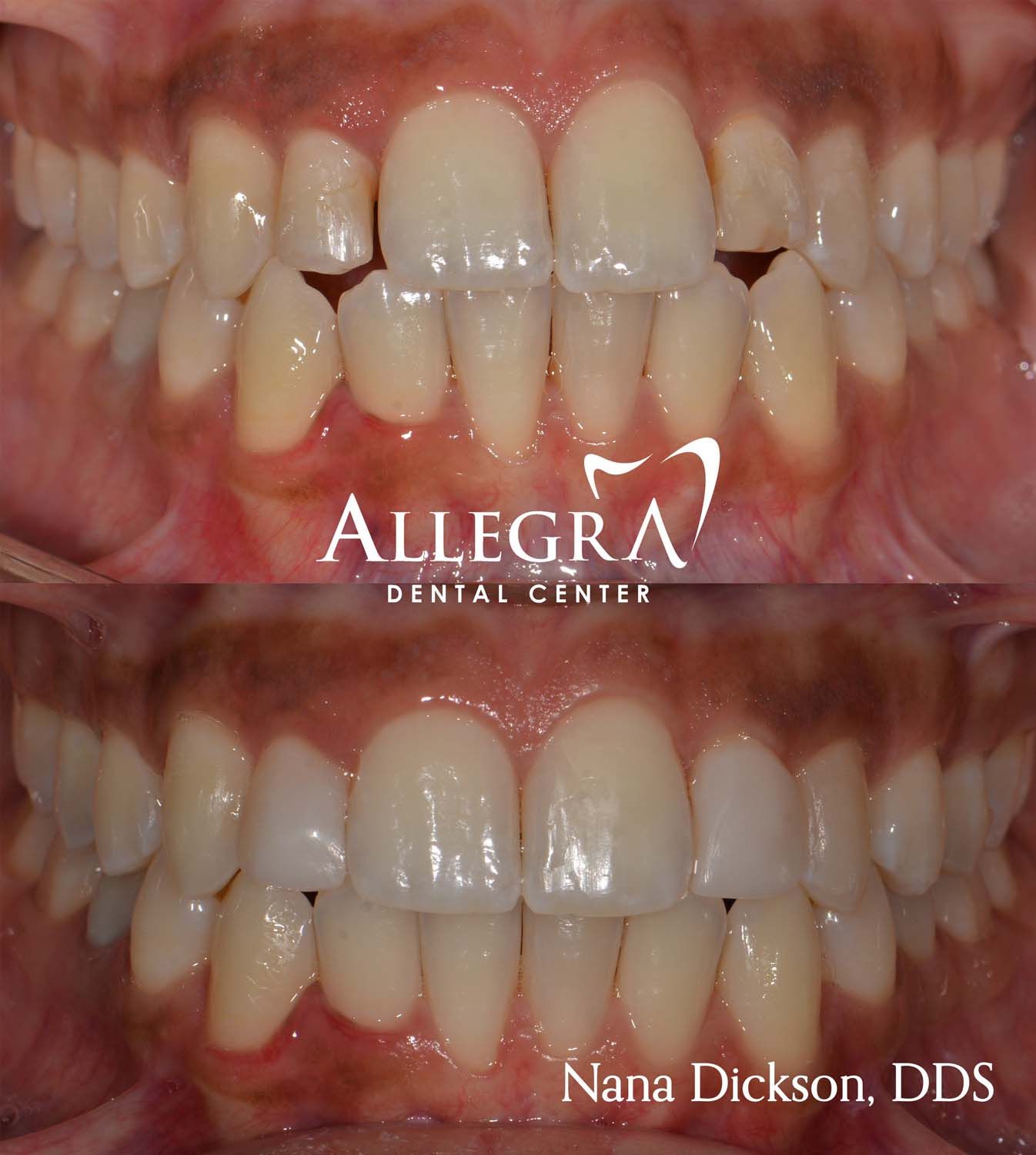 Invisalign Before and After case 41 from Allegra Dental Center