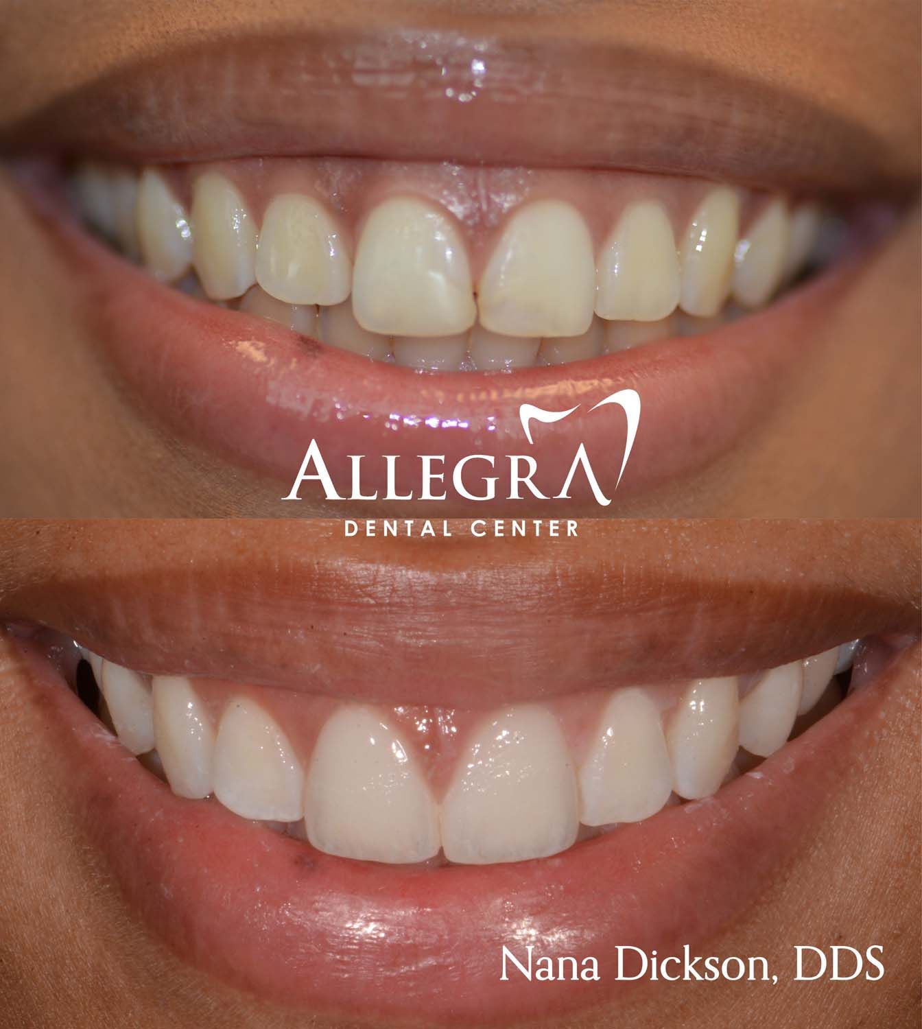 Veneers case 2 from Allegra Dental Center