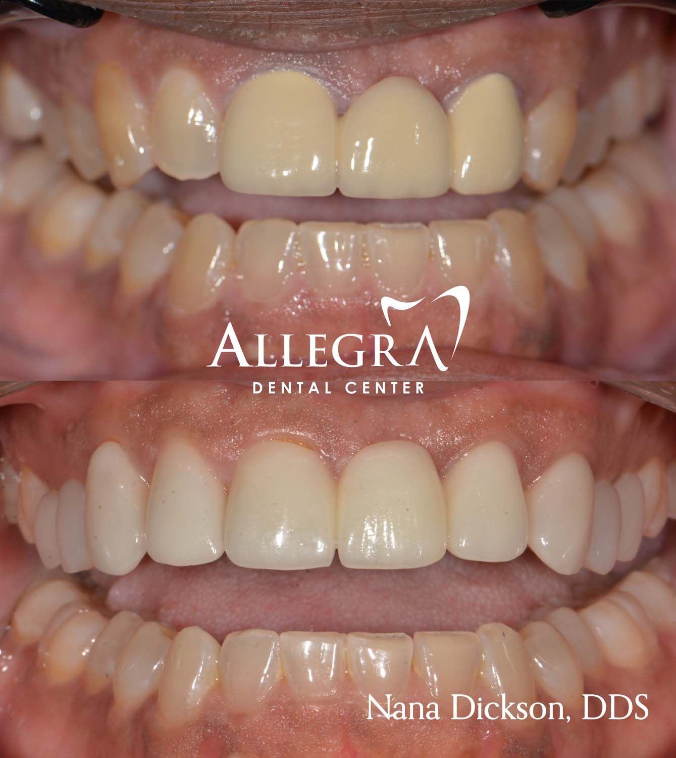 Veneers case 3 from Allegra Dental Center