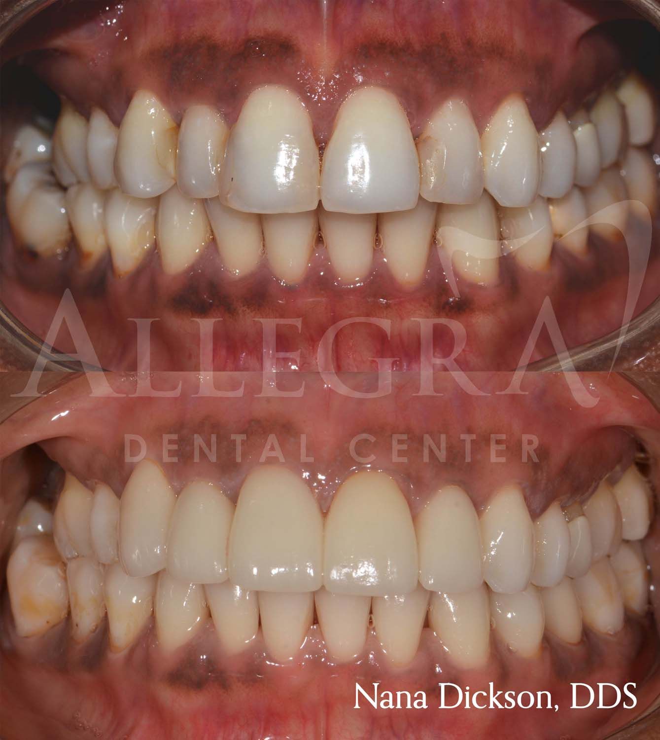 Veneers Before and After case 5 from Allegra Dental Center