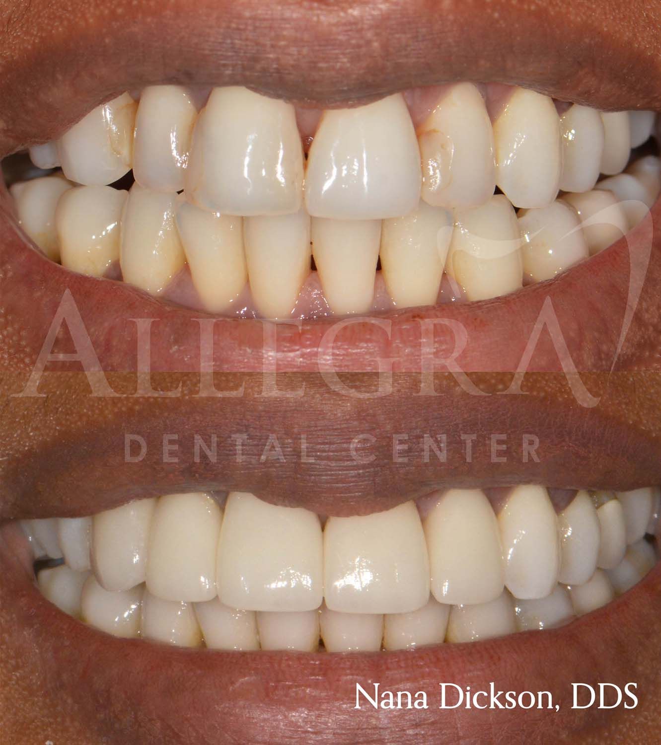 Veneers Before and After case 6 from Allegra Dental Center