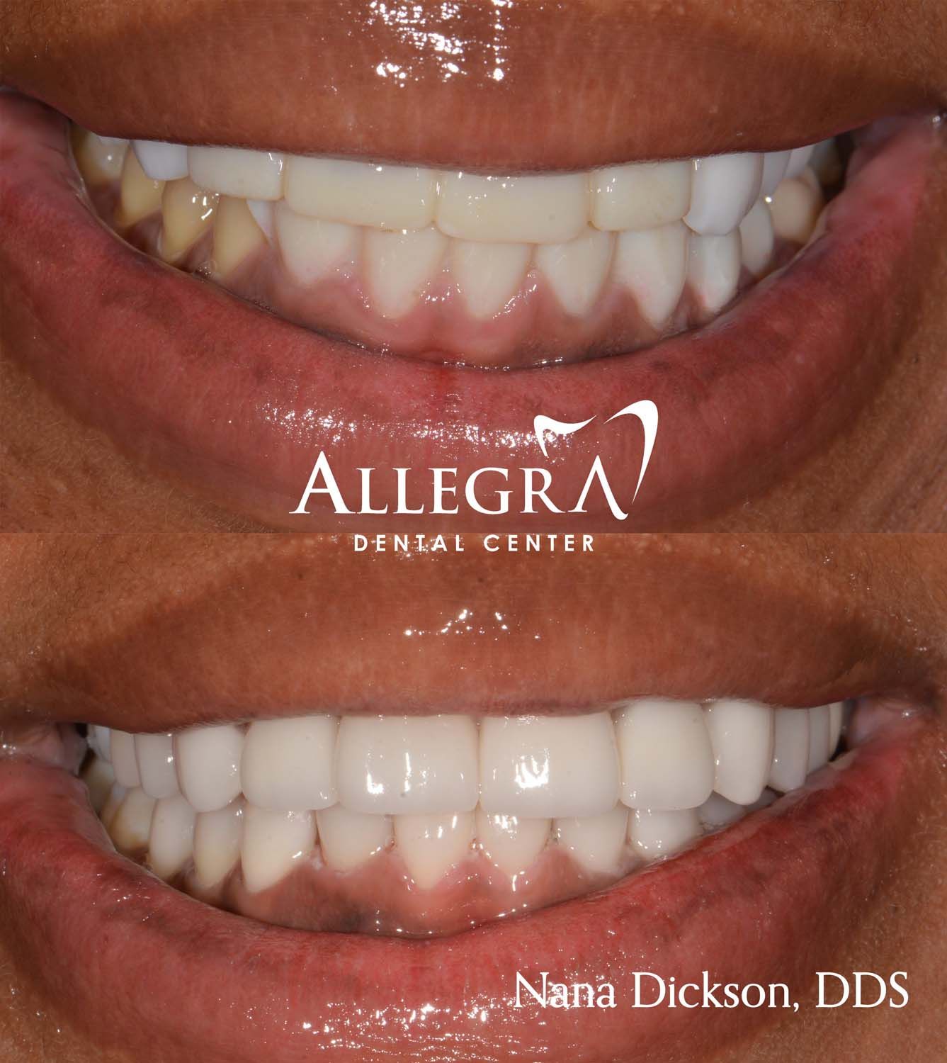Veneers Before and After case 7 from Allegra Dental Center