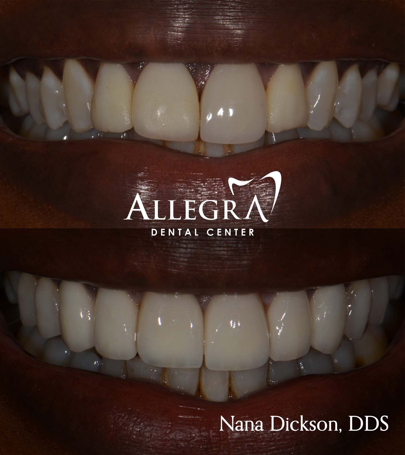 Veneers Before and After case 8 from Allegra Dental Center