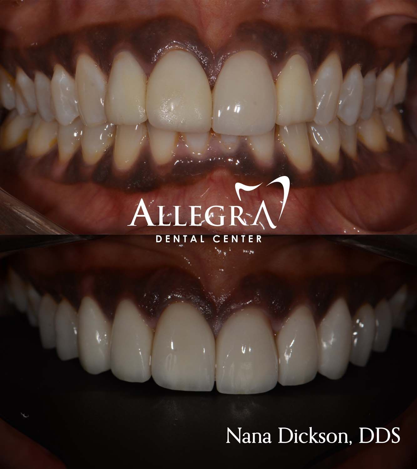 Veneers Before and After case 9 from Allegra Dental Center