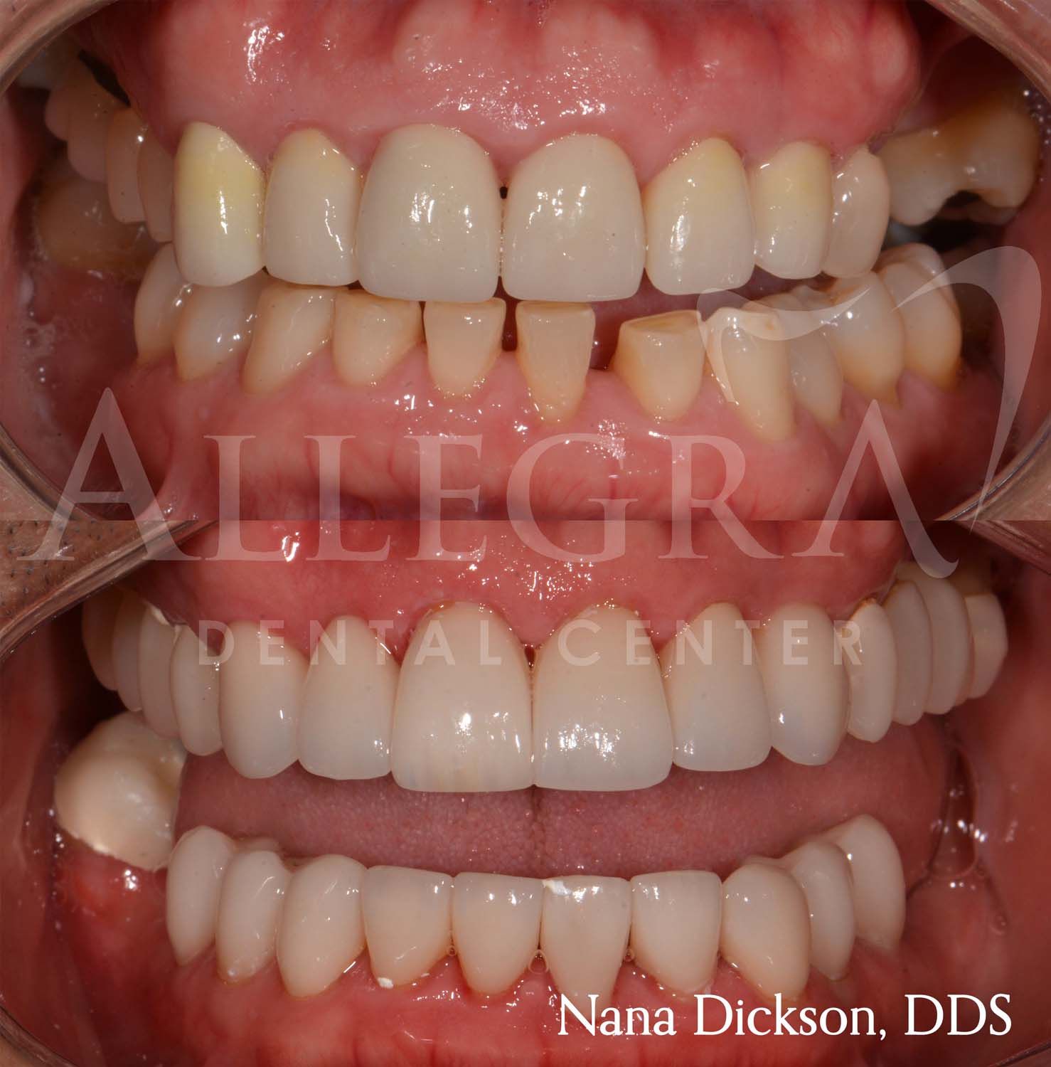 Veneers Before and After case 10 from Allegra Dental Center
