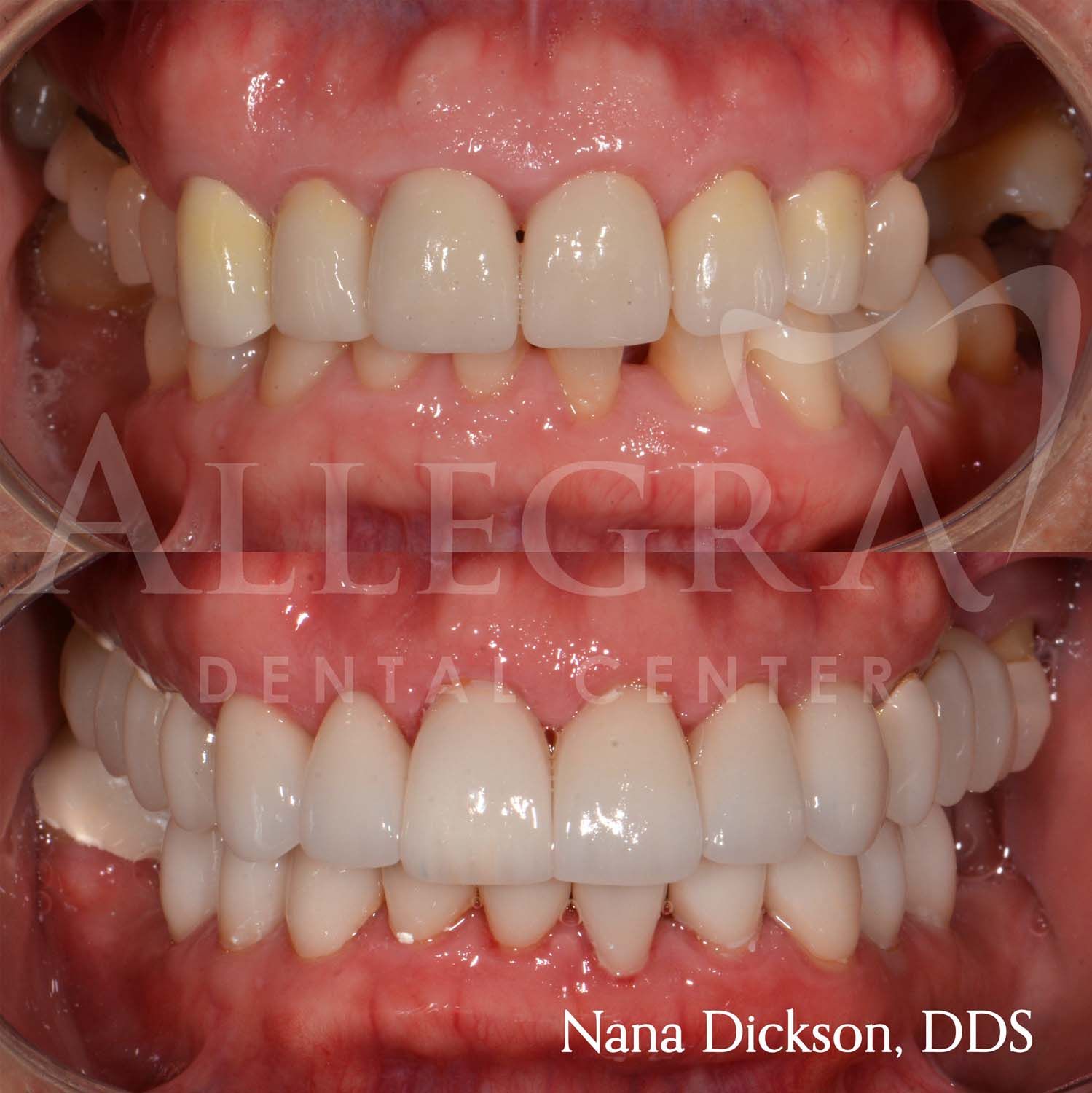 Veneers Before and After case 11 from Allegra Dental Center