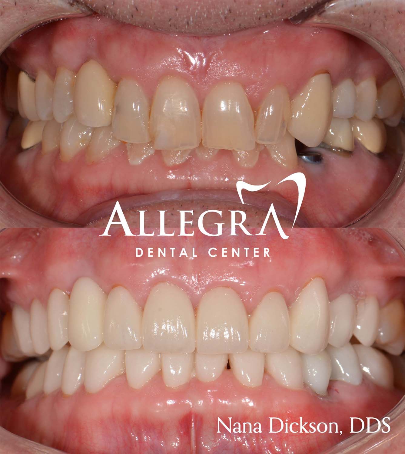 Veneers Before and After case 12 from Allegra Dental Center