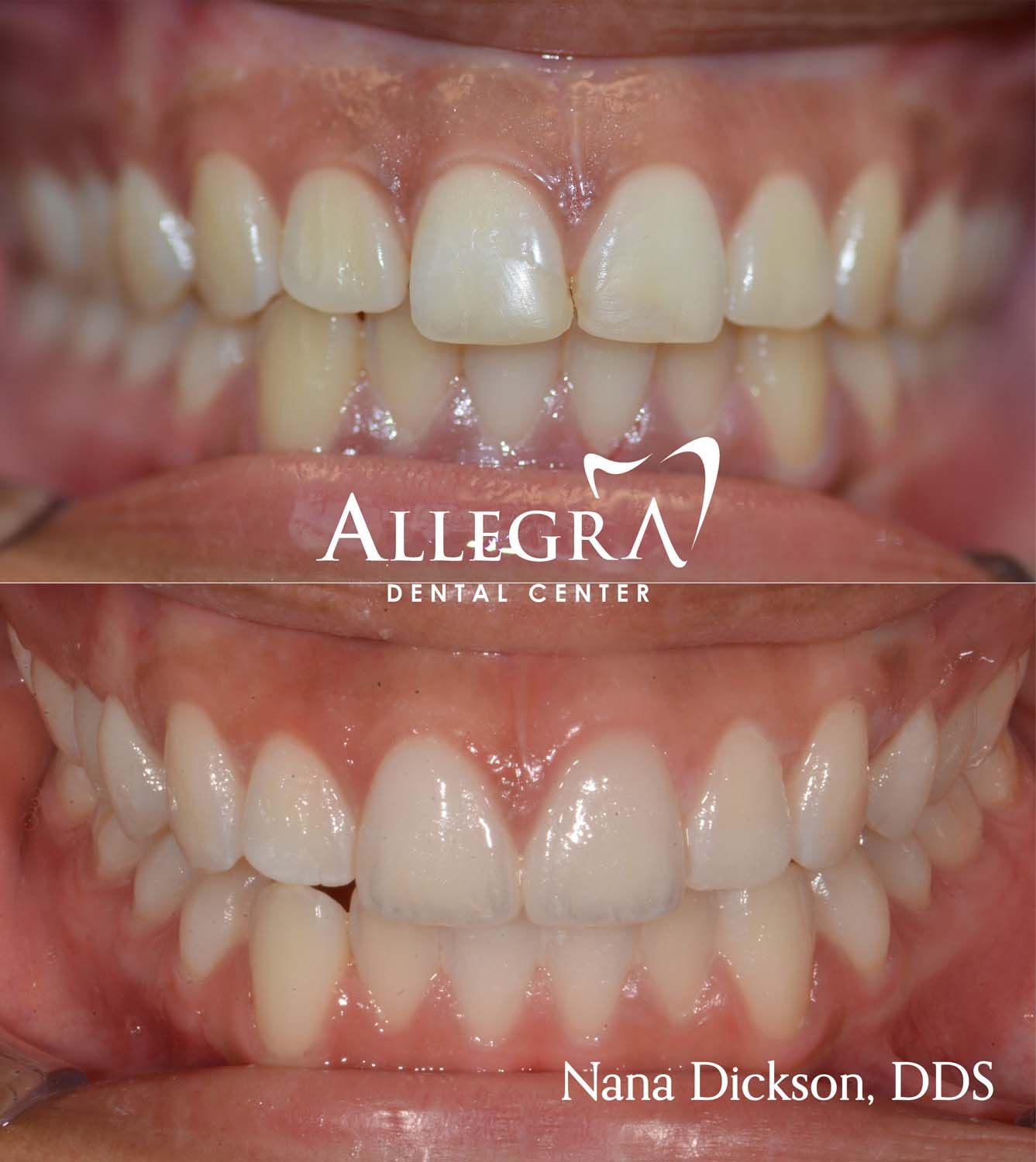 Veneers Before and After case 13 from Allegra Dental Center