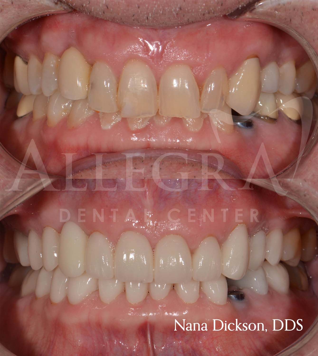 Veneers Before and After case 14 from Allegra Dental Center