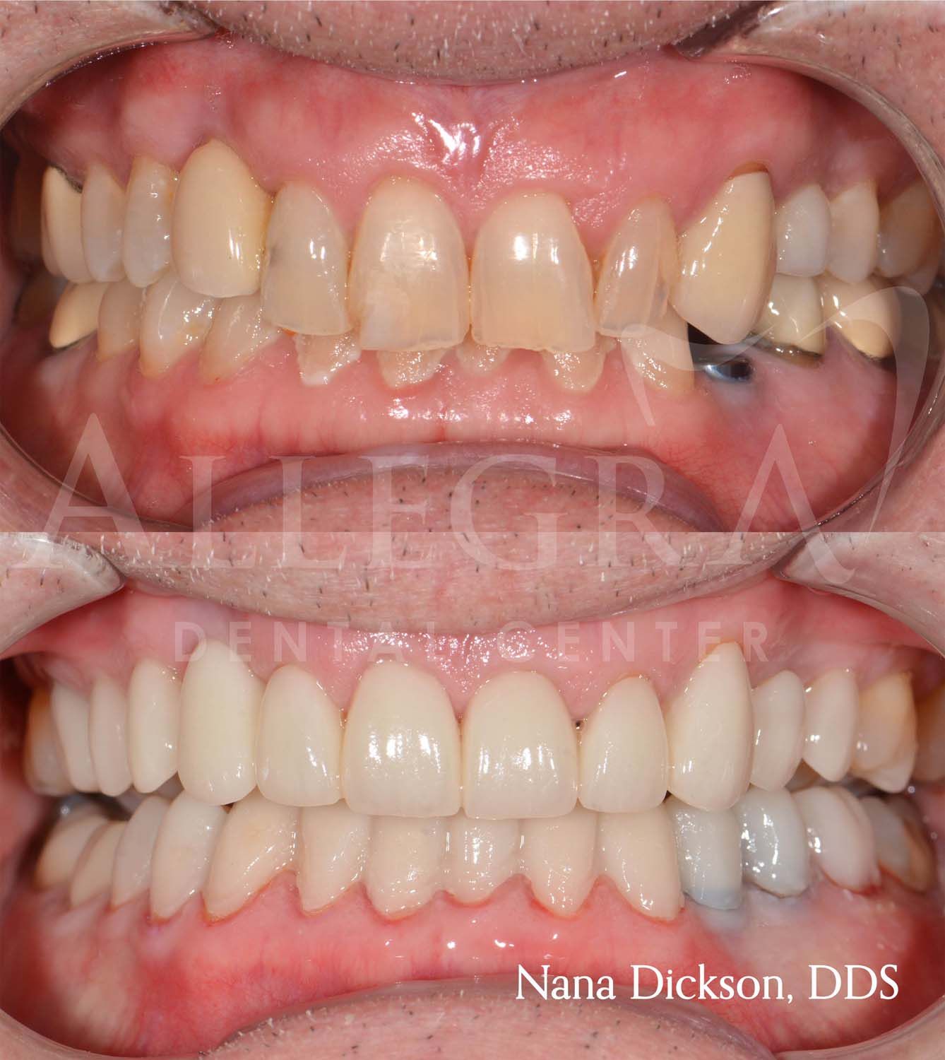Veneers Before and After case 15 from Allegra Dental Center