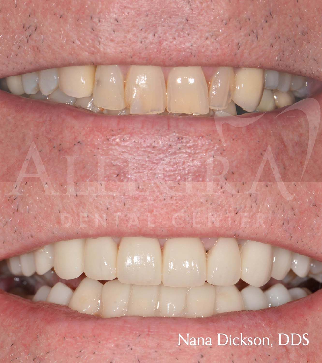Veneers Before and After case 19 from Allegra Dental Center