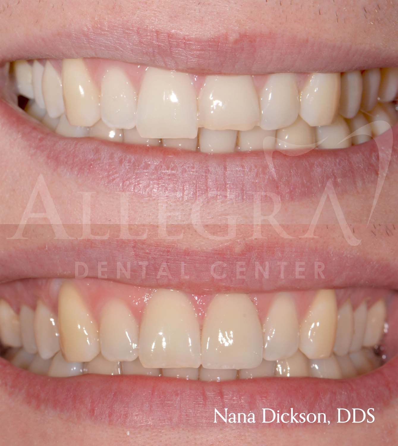 Veneers Before and After case 20 from Allegra Dental Center