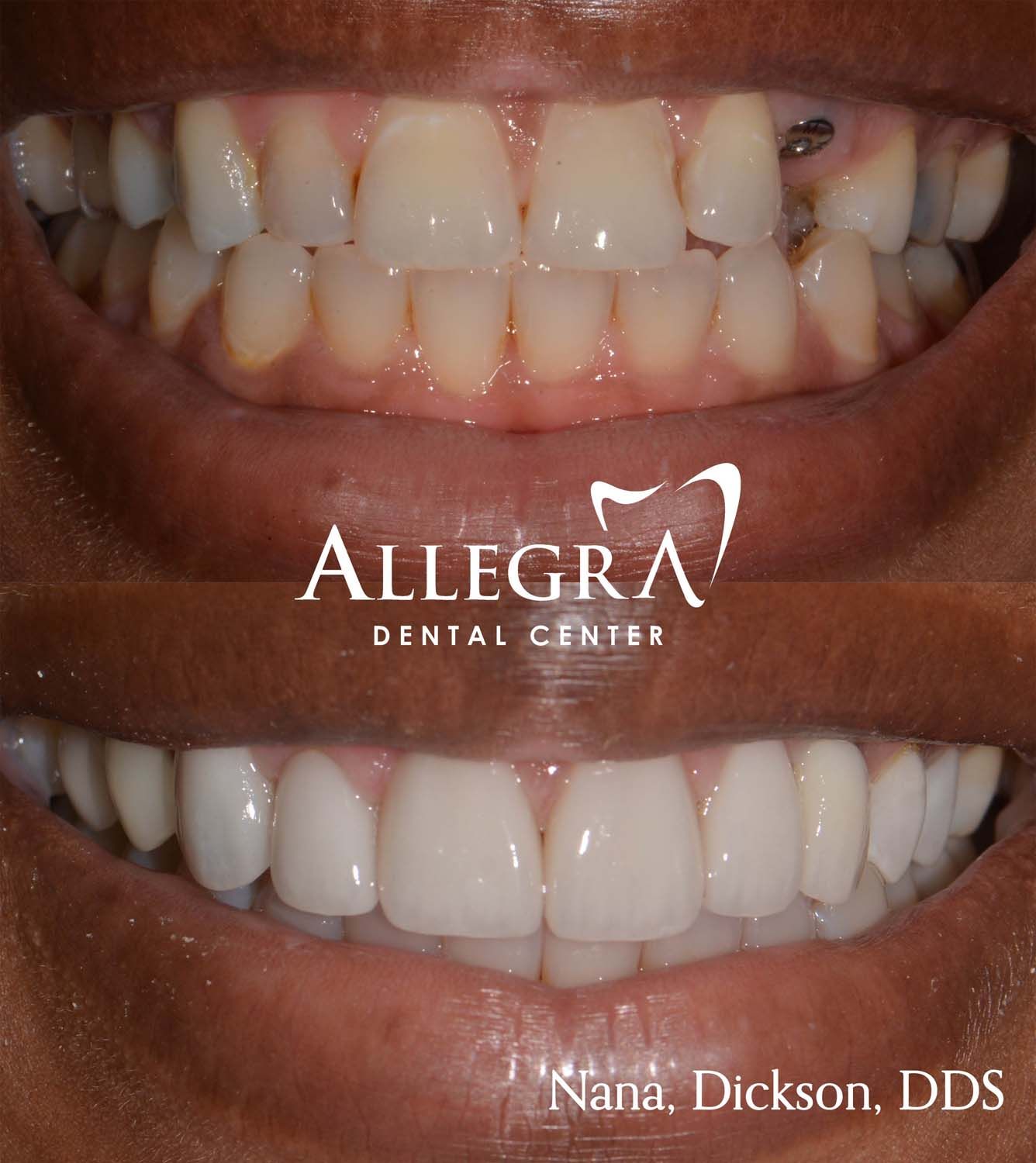 Veneers Before and After case 22 from Allegra Dental Center