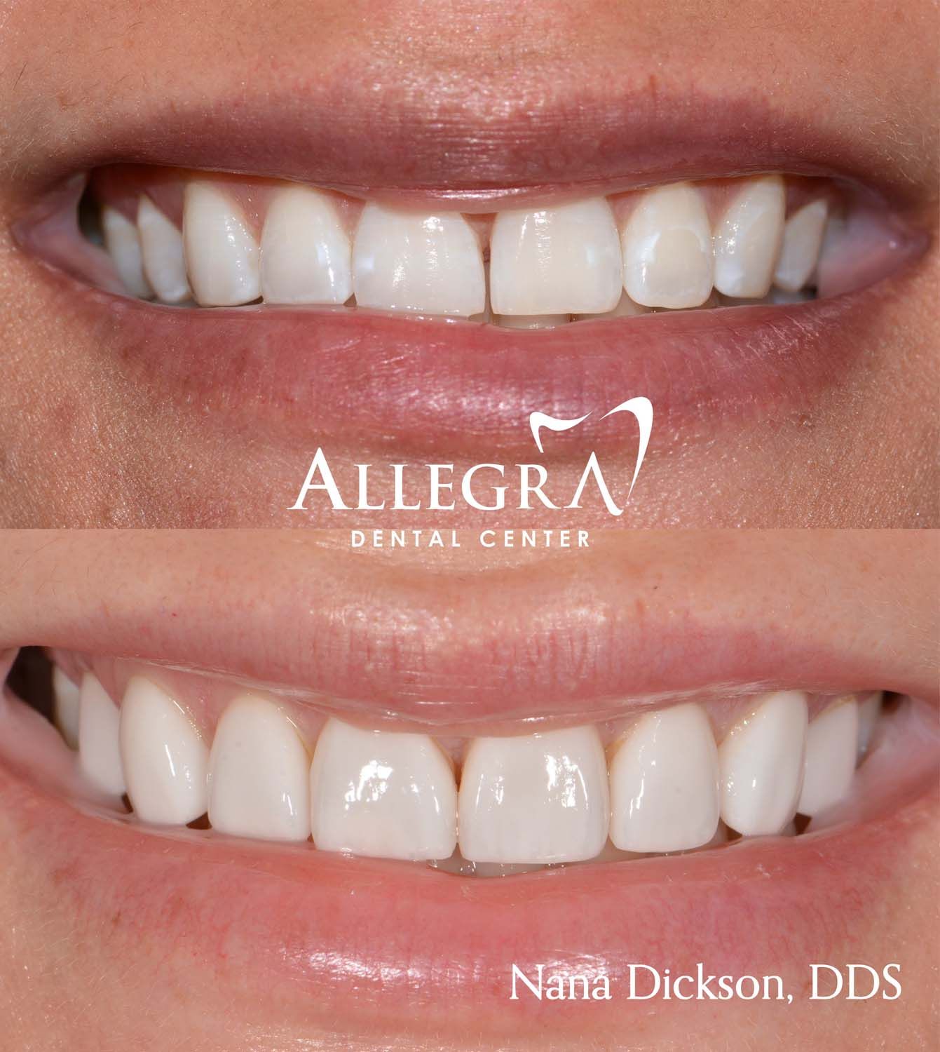 Veneers Before and After case 23 from Allegra Dental Center
