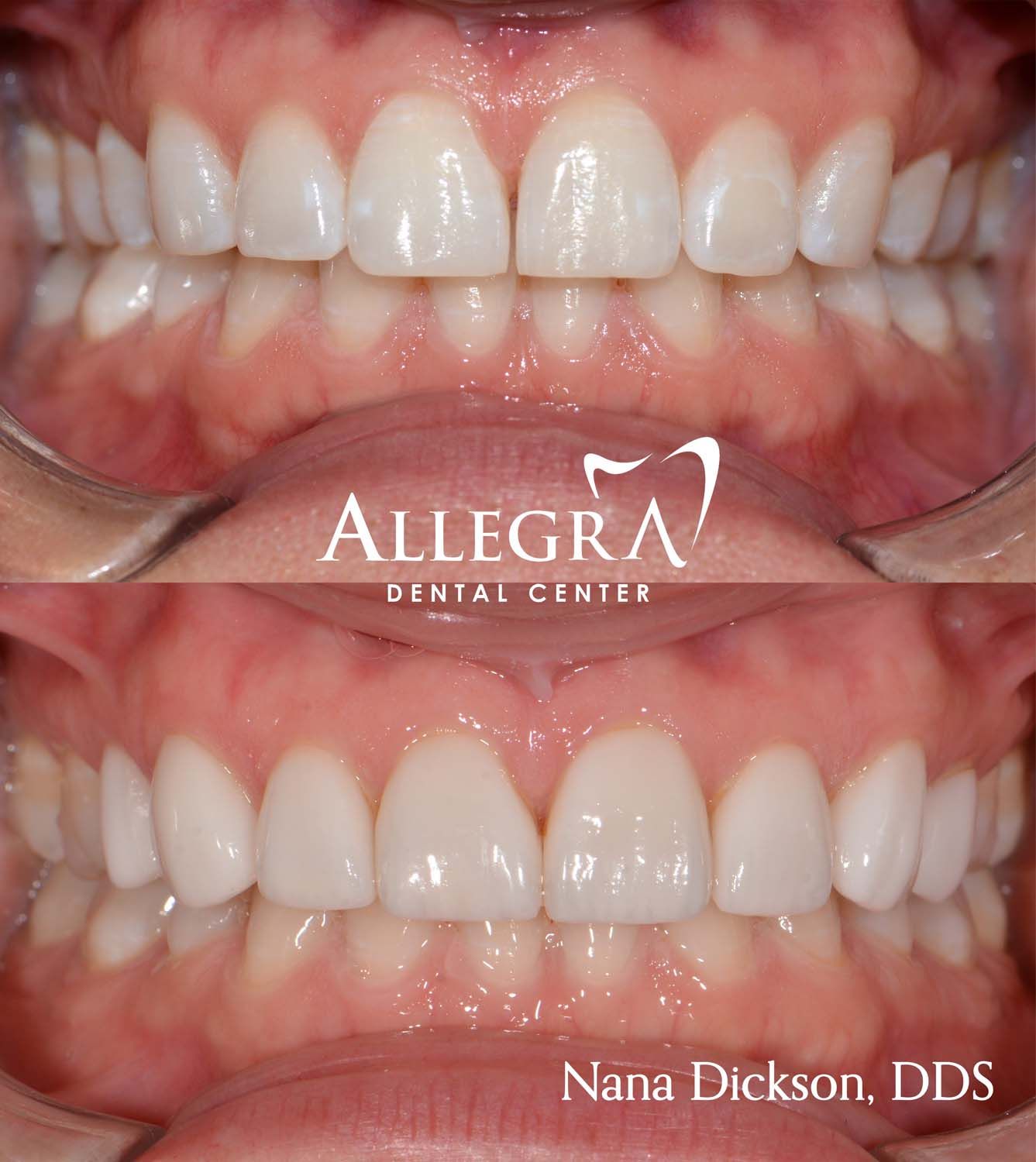 Veneers Before and After case 24 from Allegra Dental Center