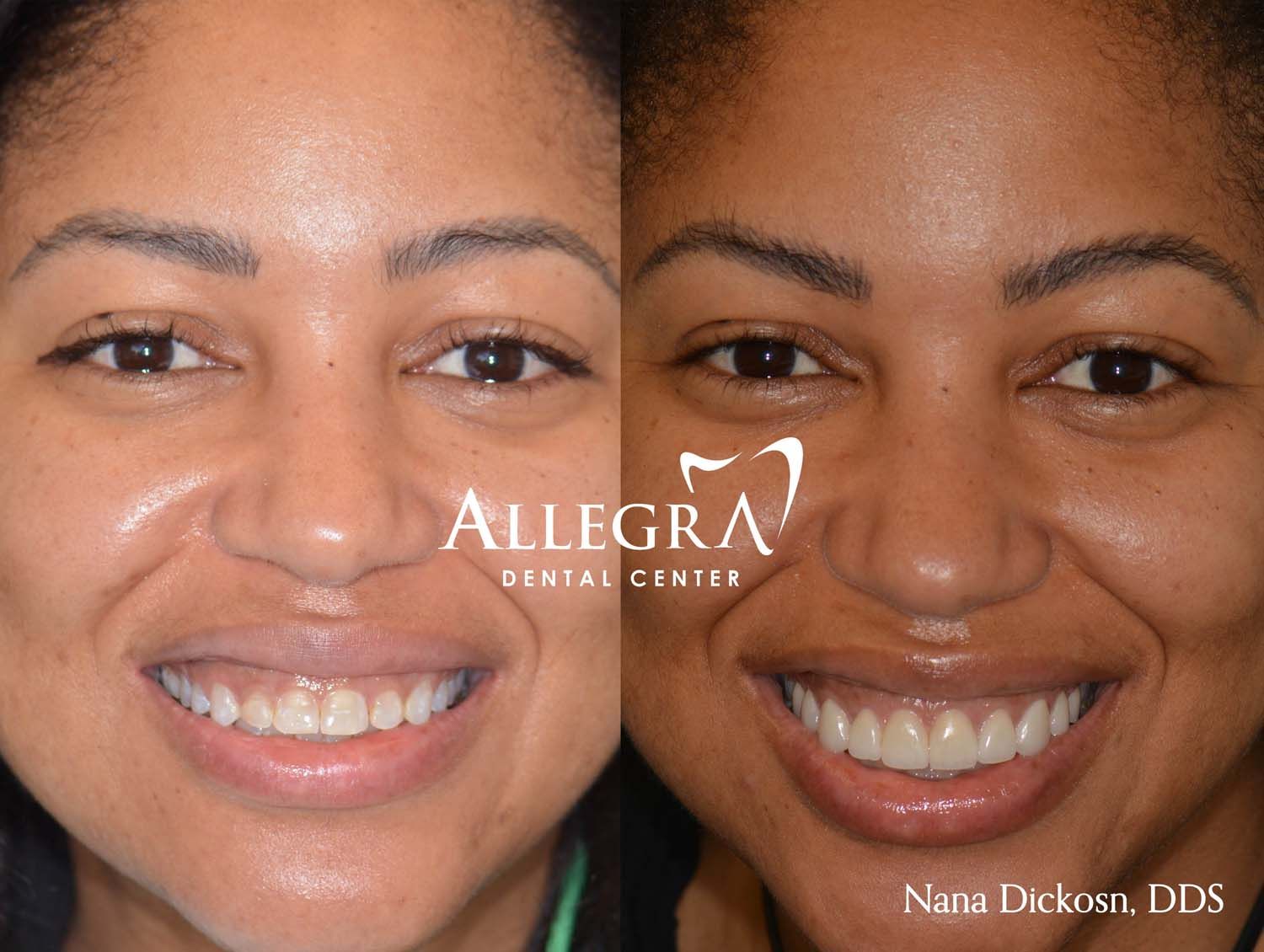 Veneers Before and After case 26 from Allegra Dental Center