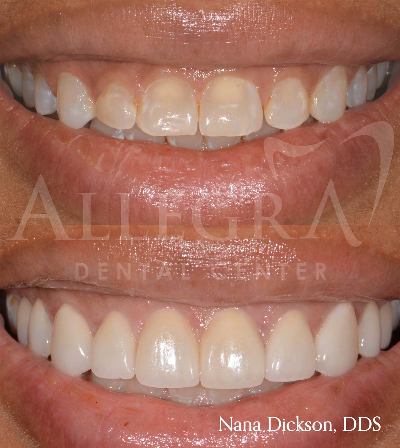 Veneers Before and After case 27 from Allegra Dental Center