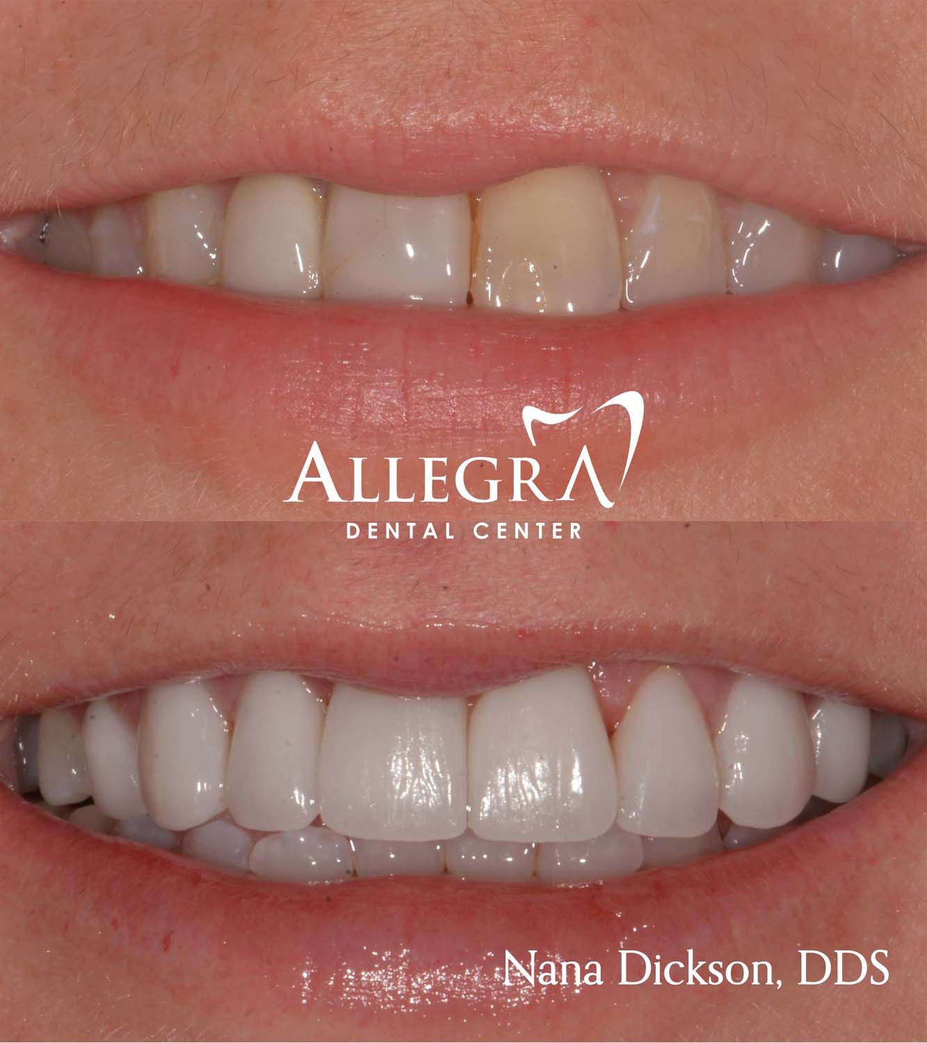 Veneers Before and After case 28 from Allegra Dental Center