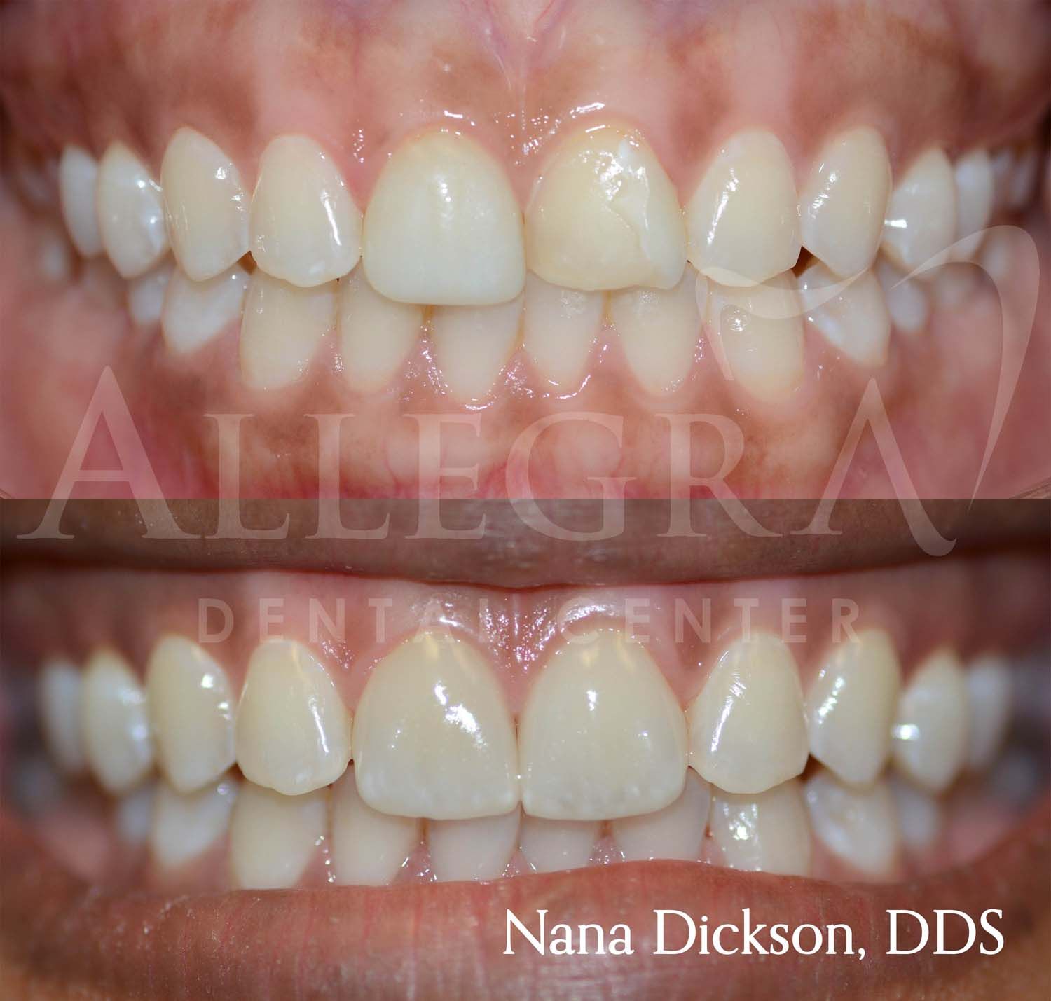 Veneers Before and After case 29 from Allegra Dental Center