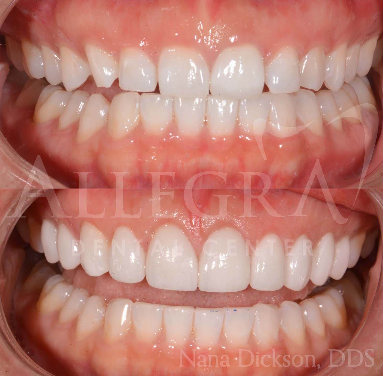 Veneers Before and After case 30 from Allegra Dental Center