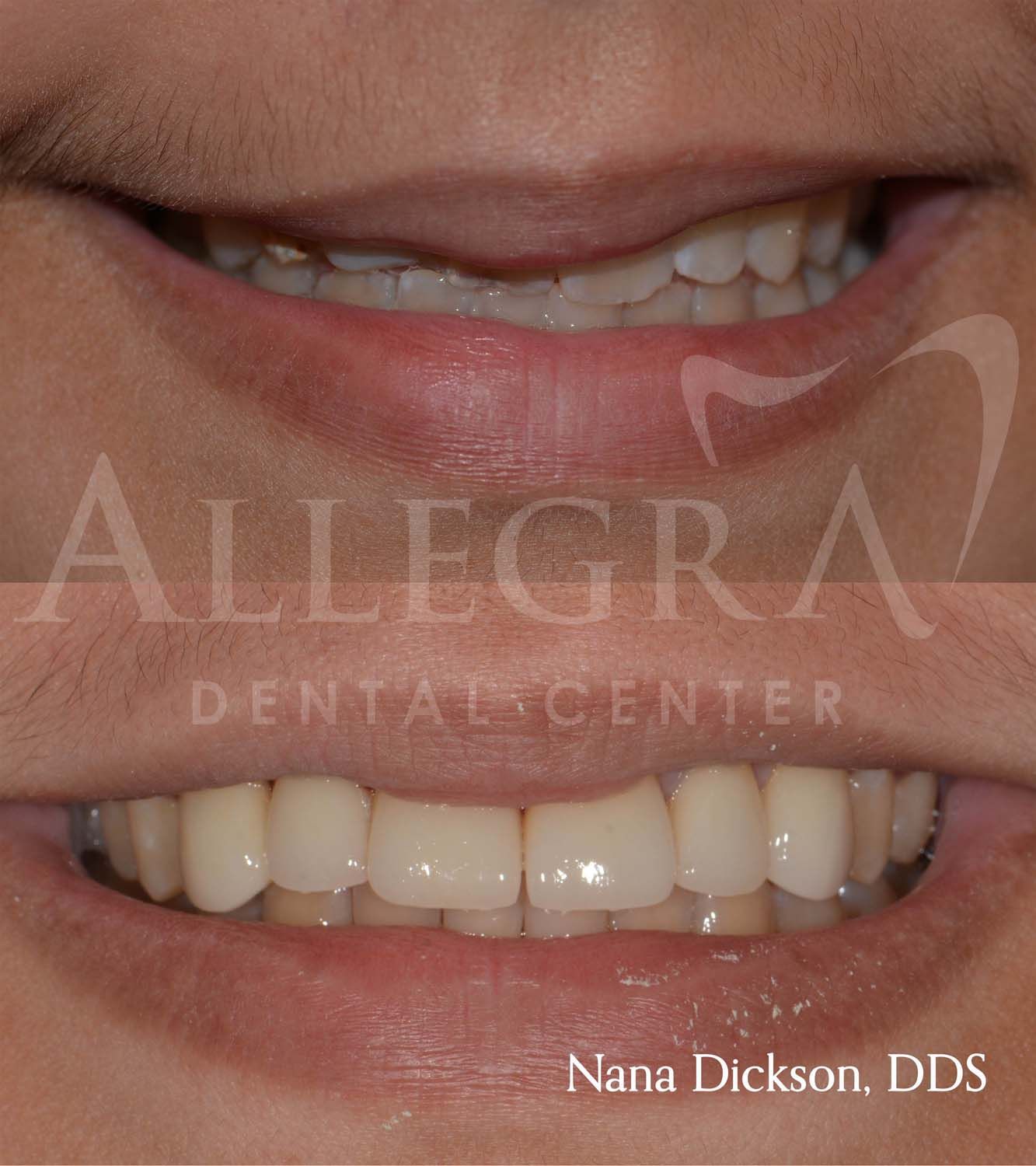 Veneers Before and After case 31 from Allegra Dental Center