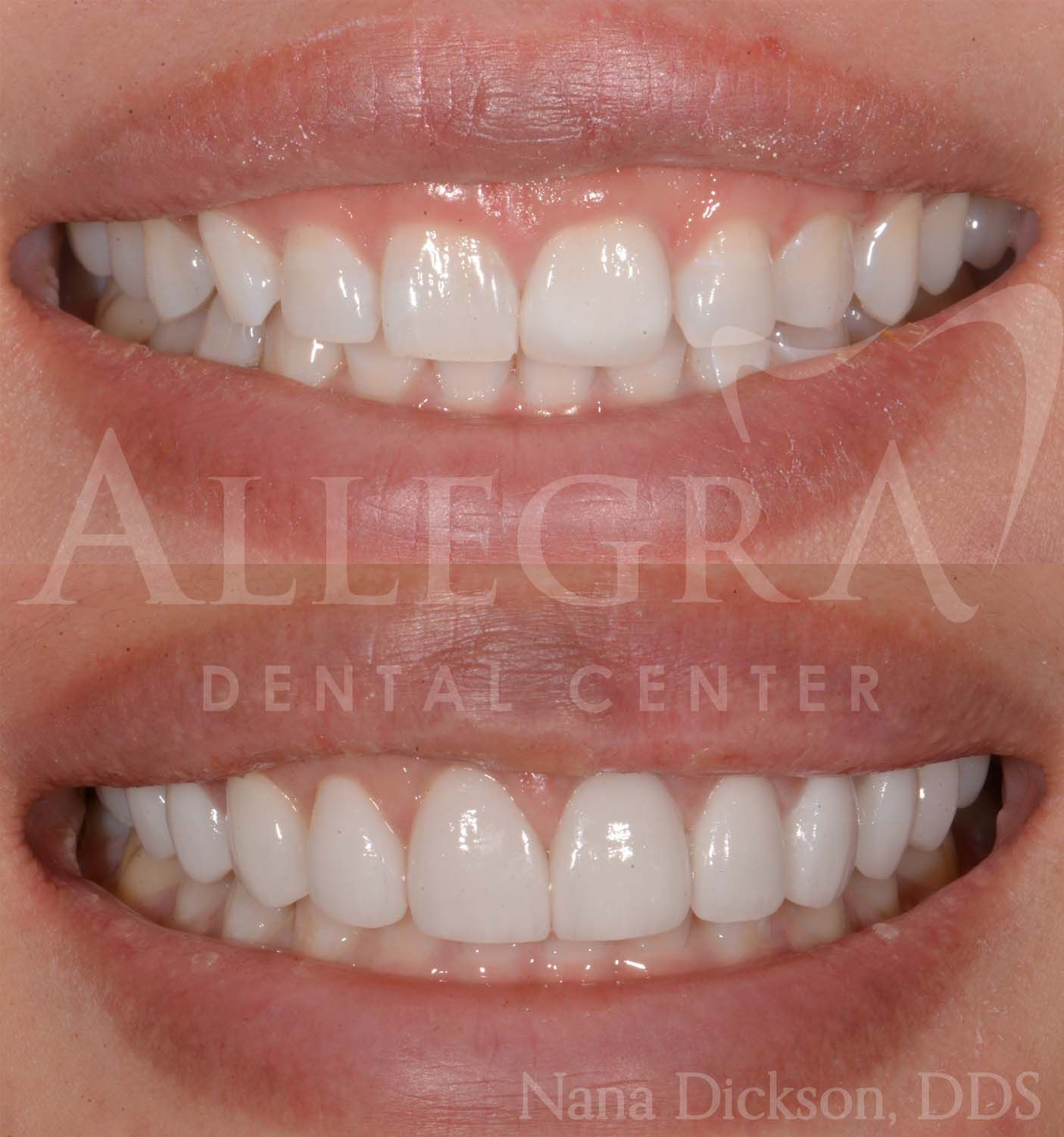 Veneers case 1 from Allegra Dental Center