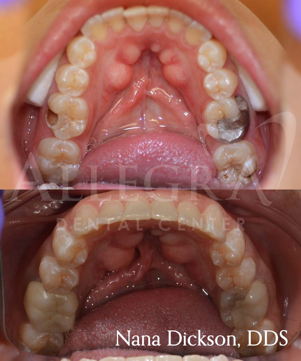 Invisalign Before and After case 44 from Allegra Dental Center
