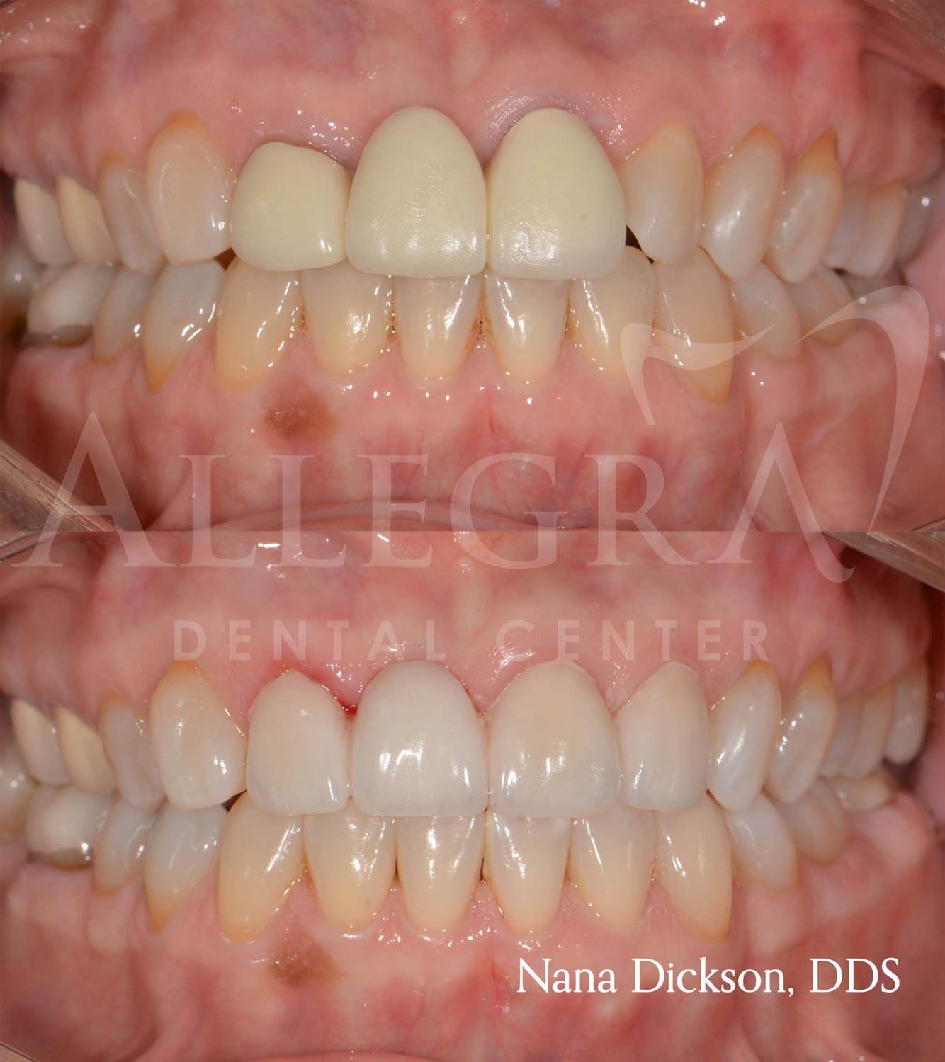 Veneers Before and After case 32 from Allegra Dental Center