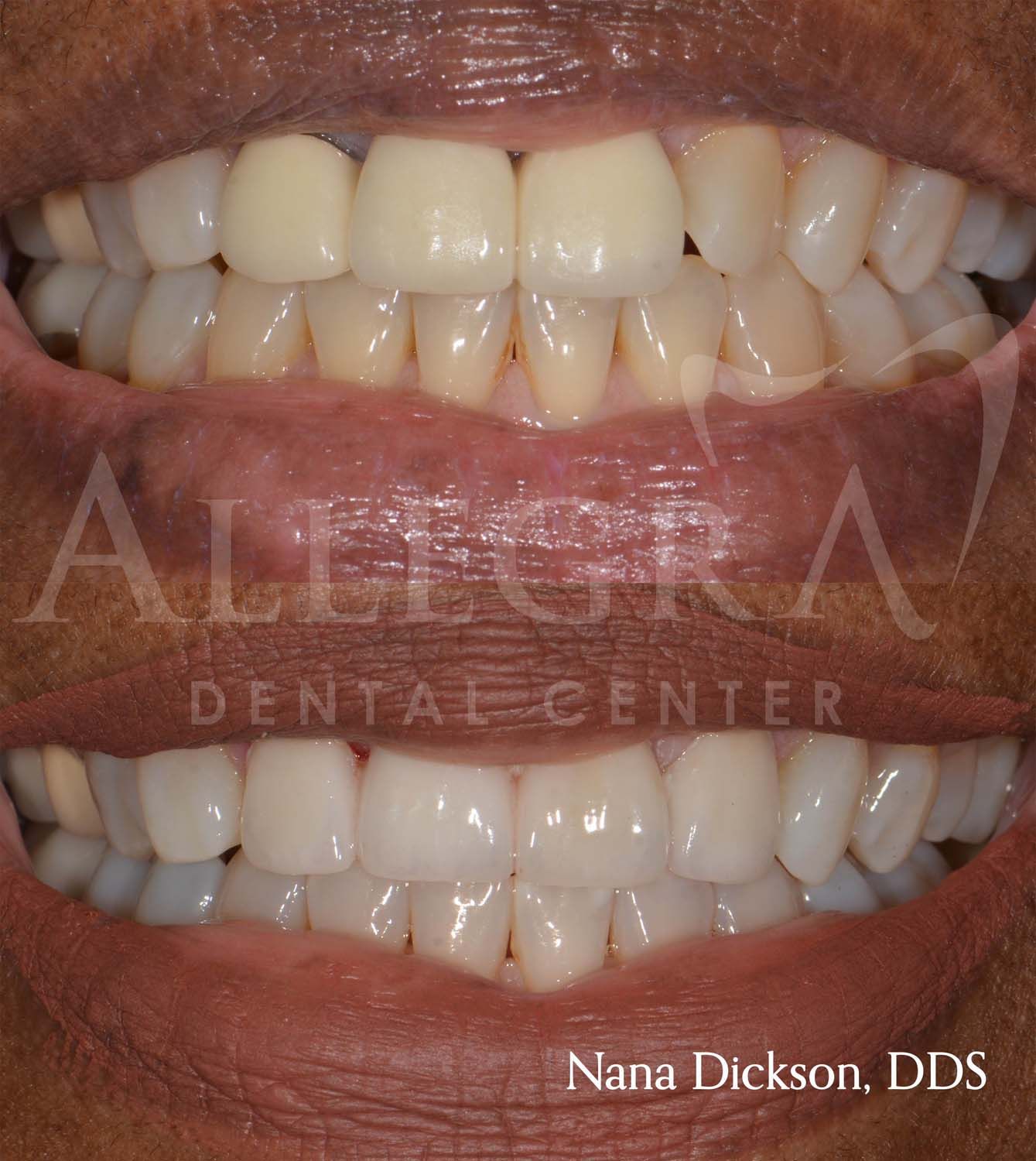 Veneers Before and After case 33 from Allegra Dental Center