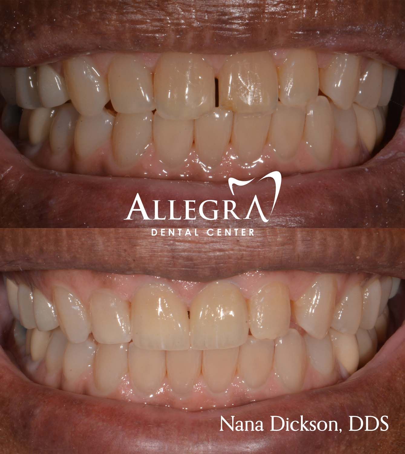 Veneers Before and After case 34 from Allegra Dental Center